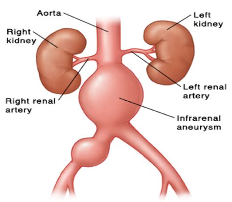 emDOCs.net – Emergency Medicine EducationAbdominal Aortic Aneurysm: Clinical Highlights/Updates ...