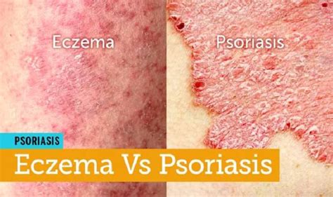 Scalp Eczema vs. Psoriasis