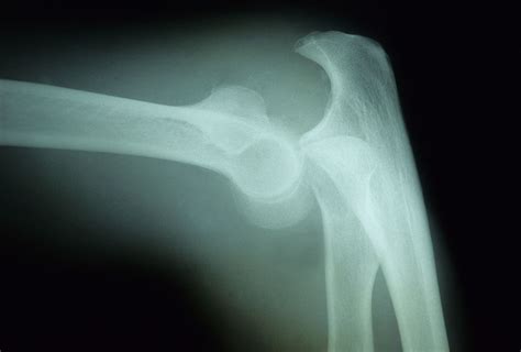 Elbow Dislocation Causes, Symptoms, and Treatment