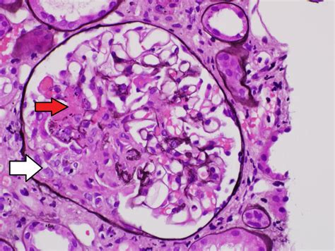 Kidney Biopsy of the Month: Lupus Nephritis - Renal Fellow Network