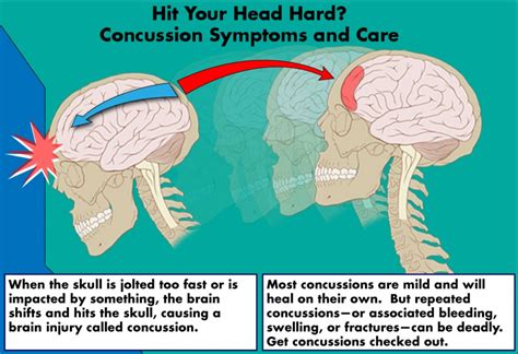 Hit Your Head Hard? Concussion Symptoms and Care | Healdove