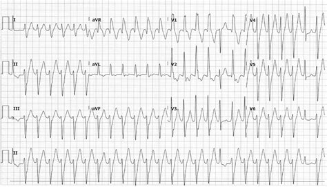 Polymorphic Ventricular Tachycardia Ecg