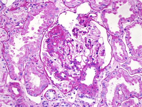 FSGS – American Society of Pediatric Nephrology (ASPN)