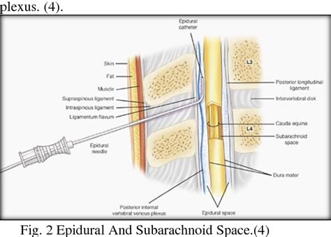 Table 4 from SINGLE -DOSE INTRATHECAL ANALGESIA TO CONTROL LABOR PAIN IS A USEFUL ALTERNATIVE TO ...