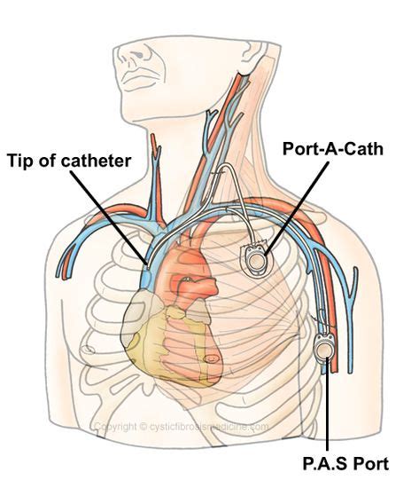 Port a Cath Placement | Venous Access And Ports | Child life specialist ...