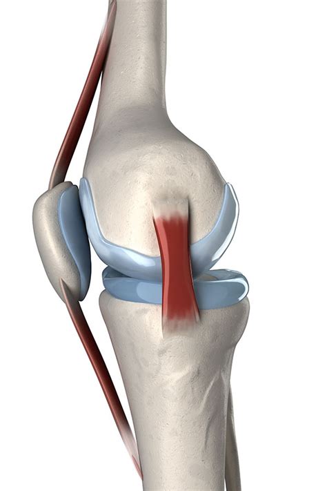 Medial Collateral Ligament injury - Knee Ligament sprain: Knee ligament Physio PTA