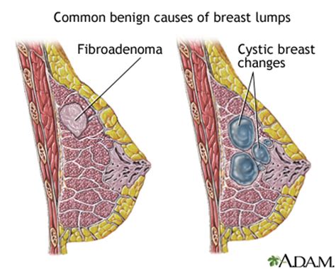 Breast lump | UF Health, University of Florida Health