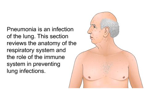 PatEdu.com : Pneumonia