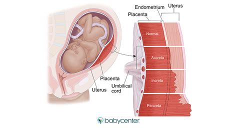 High-risk pregnancy: what to know about placenta accreta | BabyCenter