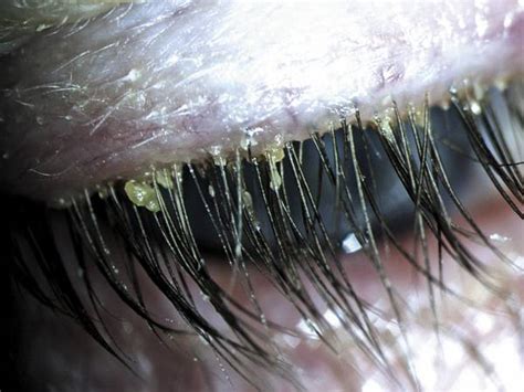 Demodex Eyelash Mites