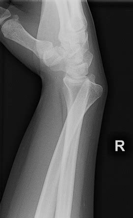 Distal radioulnar joint dislocation | Radiology Reference Article | Radiopaedia.org