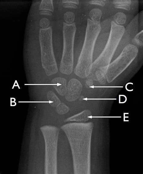 Radiograph of the ossification centres of a child’s wrist | The BMJ