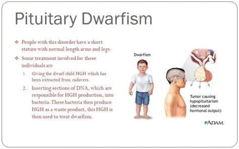 Pituitary dwarfism (GH deficiency) - SMARTY PANCE