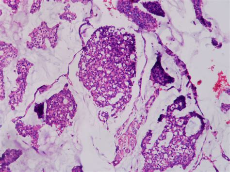 MUCINOUS CARCINOMA – Histopathology.guru