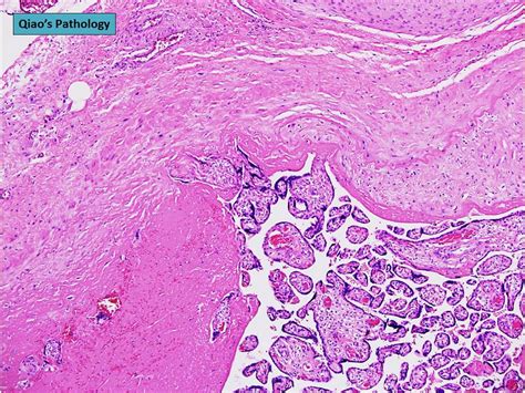 Qiao's Pathology: Placenta Accreta - a photo on Flickriver