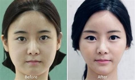 81 photos of plastic surgery in Korea that will make your jaw drop - Stomp