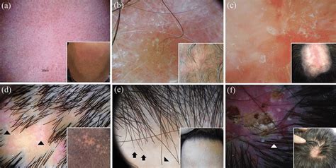 0Dermoscopy of discoid lupus erythematosus of the scalp varies... | Download Scientific Diagram