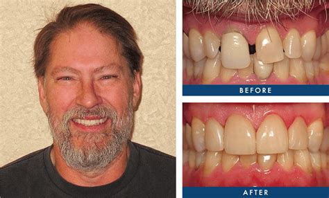 Before & After Photos | Smile Design Dentistry | Plymouth, MN