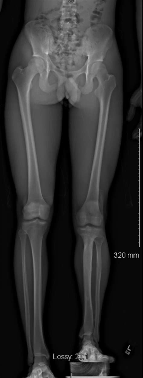 Pin on Pelvic torsion