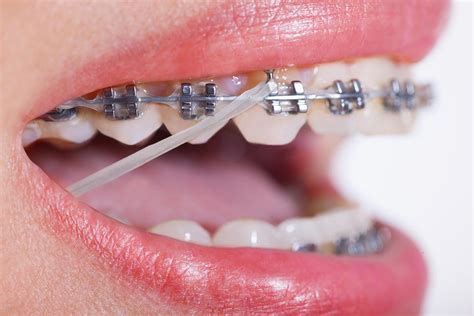 Why Do People Wear Rubber Bands With Braces? : Farr West Orthodontics