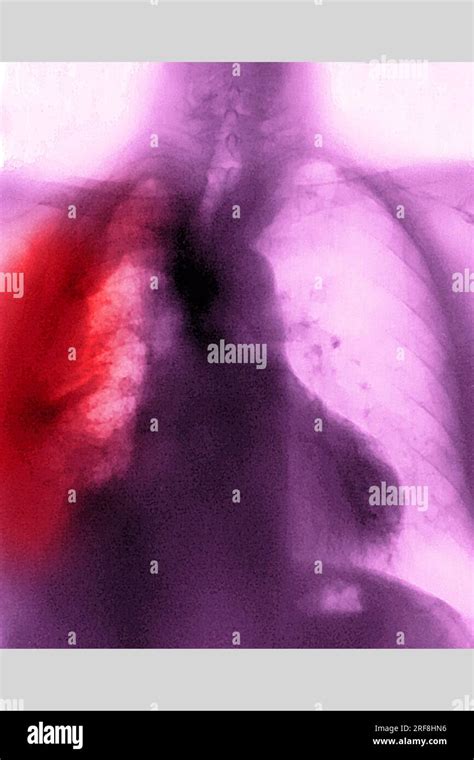 Chest X Ray Showing The Lungs Heart Ribs Stock Image - vrogue.co