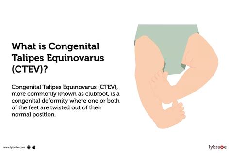 Congenital Talipes Equinovarus (CTEV): Causes, Symptoms, Treatment and Cost