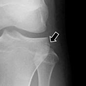 Arcuate sign | Radiology Reference Article | Radiopaedia.org | Radiology, Avulsion fracture ...
