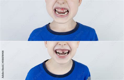 Before and after. Falling out milk tooth. Blond boy in photo has a ...