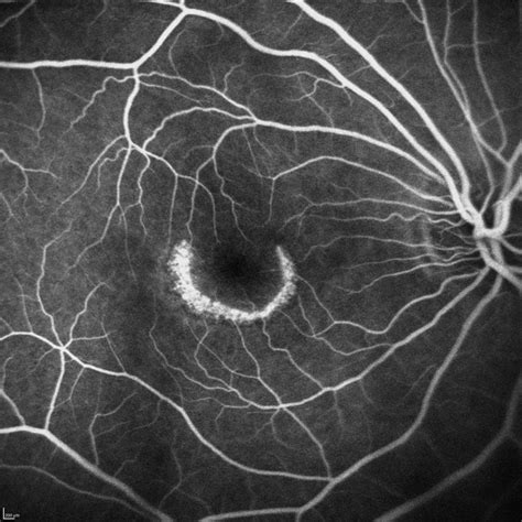 Plaquenil Toxicity Fluorescein Angiogram - Retina Image Bank