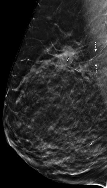 Regional Calcifications | Radiology Key