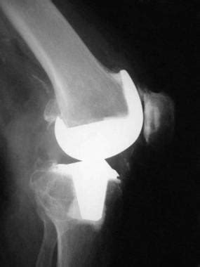 Complications of Total Knee Arthroplasty: Background, Complications ...