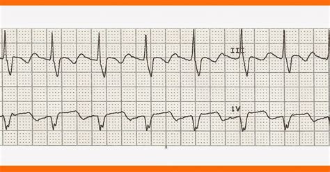 Float Nurse: Practice EKG Rhythm Strips 211