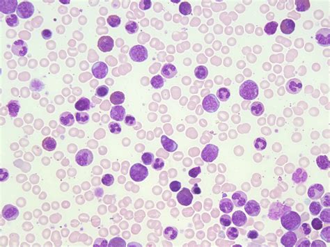 Chronic Myelogenous Leukemia (CML) – A Laboratory Guide to Clinical ...