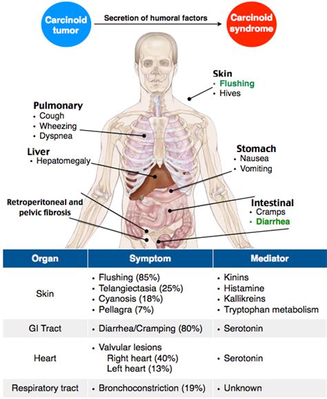 Rosh Review | Carcinoid syndrome, Neuroendocrine cancer, Medical mnemonics