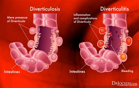 4 Steps to Heal Diverticulitis Naturally - DrJockers.com Diverticulitis ...