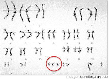 Examples of Aneuploidy