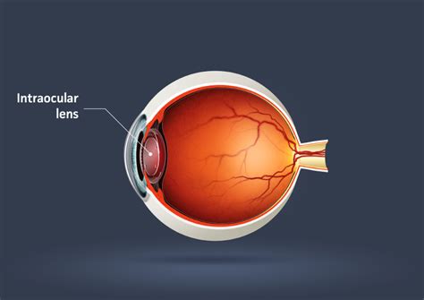 Intraocular lens - Mr Shahram Kashani