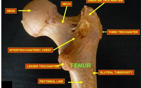 Understanding Hip Fractures: How These Breaks Differ and Why Recovery ...