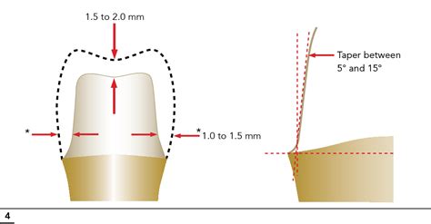 Figure 4 from Porcelain-Fused-to-Metal and All-Ceramic Crowns for ...