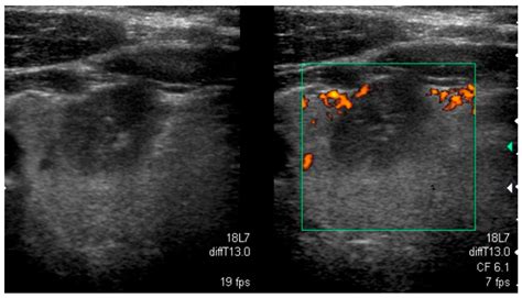 Follicular Thyroid Cancer Ultrasound