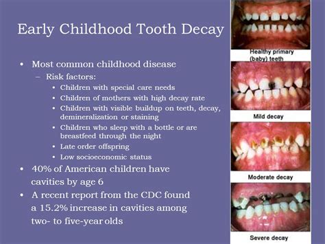 stages of tooth decay in children