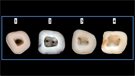 Mandibular First Molar Canals