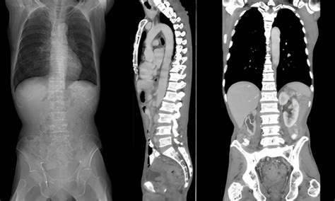 Ct Scan Spine