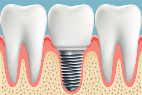 Implant-Supported Crown – Charlotte, NC – Ballantyne, NC