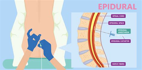 How do epidurals work? And why is there a global shortage of them?