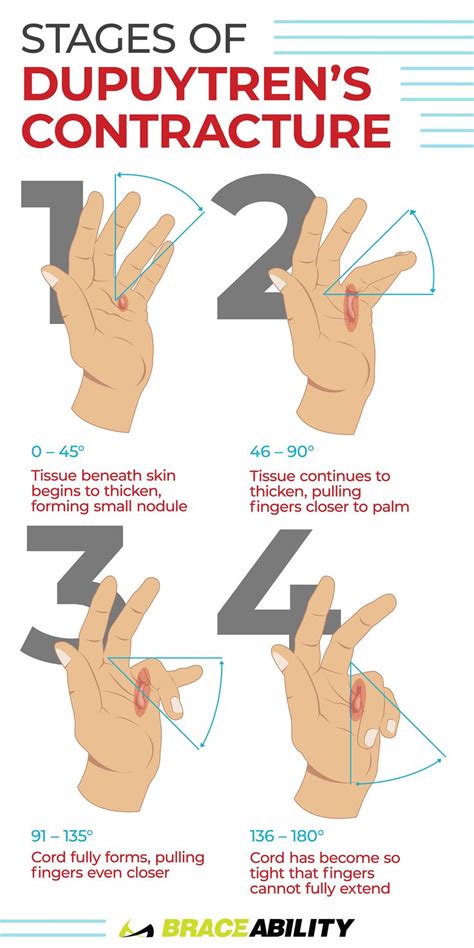 All You Need to Know About Dupuytren’s Contracture | Dupuytren's contracture, Dupuytren's ...