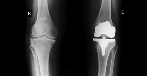 Artificial Knee Replacement Midwest City | Knee Arthroplasty Surgery ...