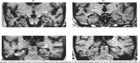 Figure 1 from Memory impairments associated with hippocampal versus parahippocampal-gyrus ...