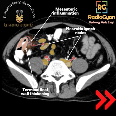 Ileocecal tuberculosis | Radiology Case | - RadioGyan