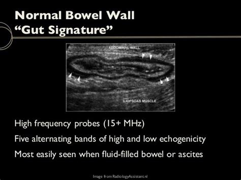 Emergency Ultrasound: Bowel